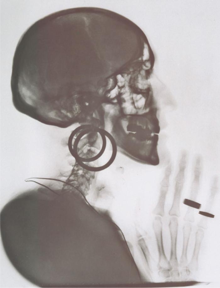Meret Oppenheim: M. O. koponyájának röntgenfelvétele (M. O. 1913–2000), 1964, magángyűjtemény, Bern © Fotó: Peter Lauri, Bern © VBK, Wien, 2013